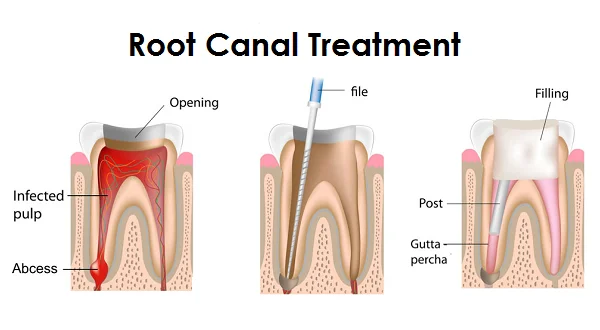 Root Canal Treatment image