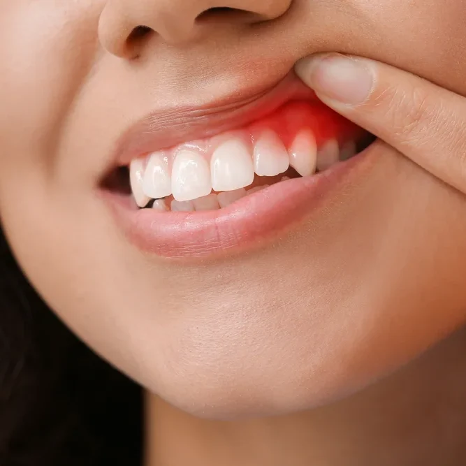 Gum Treatment in Agra
